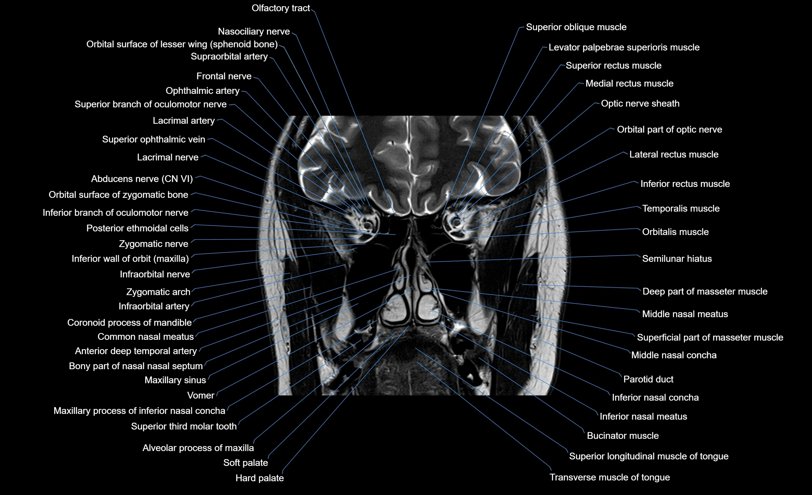 MRI face & paranasal sinuses(PNS) labelled  coronal  cross sectional anatomy 3T radiology  image-img-00001-00026.webp